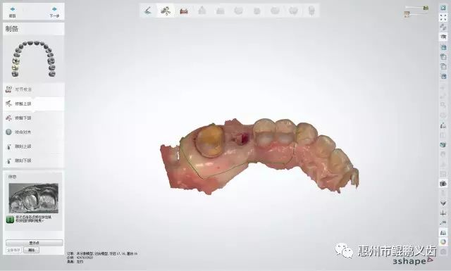口内扫描+树脂模型打印+种植修复 病例分享  